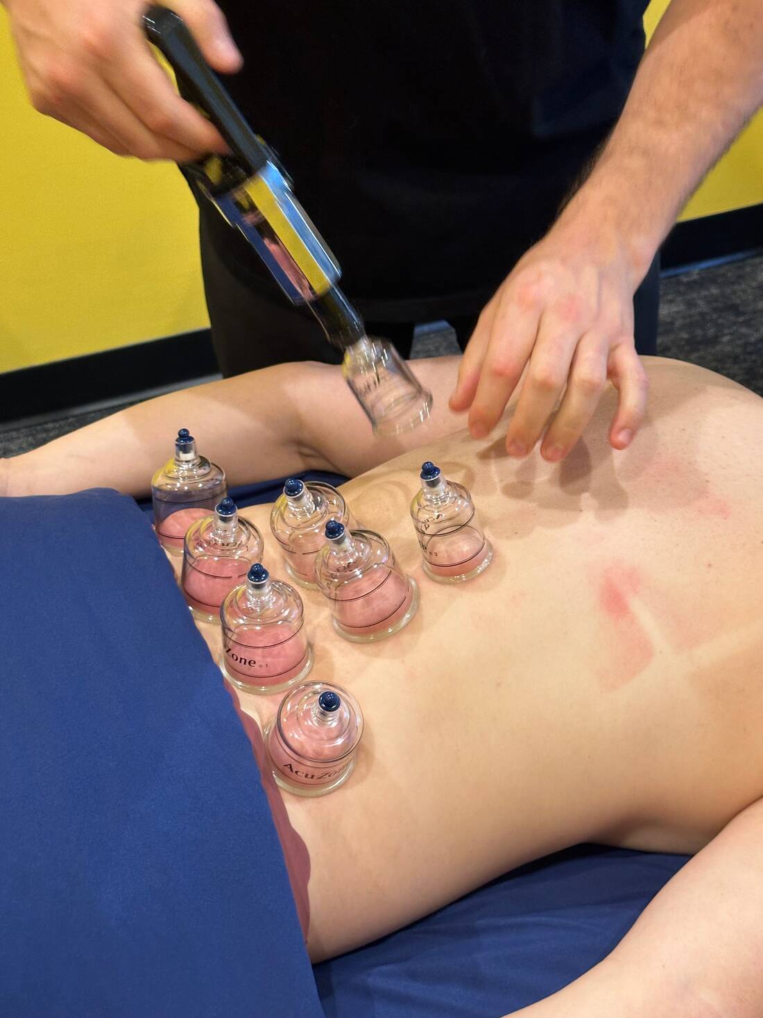 Cupping therapy on a client's back
